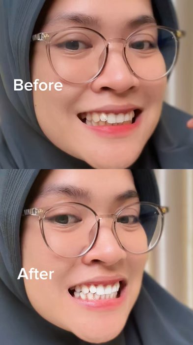 Yang punya gigi kuning wajib coba❤️#fypシ #metoosmile #metoo #metootoothpaste #pastagigi #DiskonRacunShopee #ShopeeCOD #jumatberkah