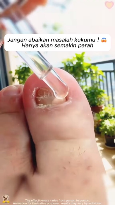 Serum kuku #serumkuku #serumkukuviral #serumkukurusak #obatkuku #obatkukurusak #obatkukujamur #ViralDiShopeeVideo #RacunShopee #serumkukumurah