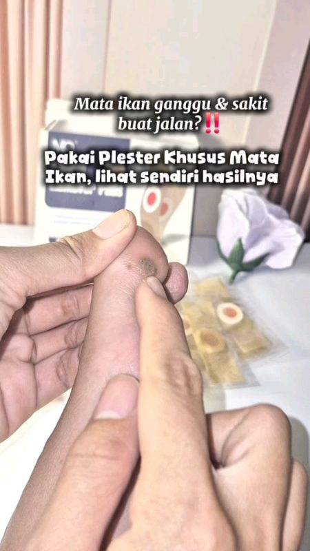 Plester mata ikan #mataikandikaki #plestermataikan #GratisOngkirRP0  #plestermataikankutildankapalan #ViralDiShopeeVideo #RacunShopee
