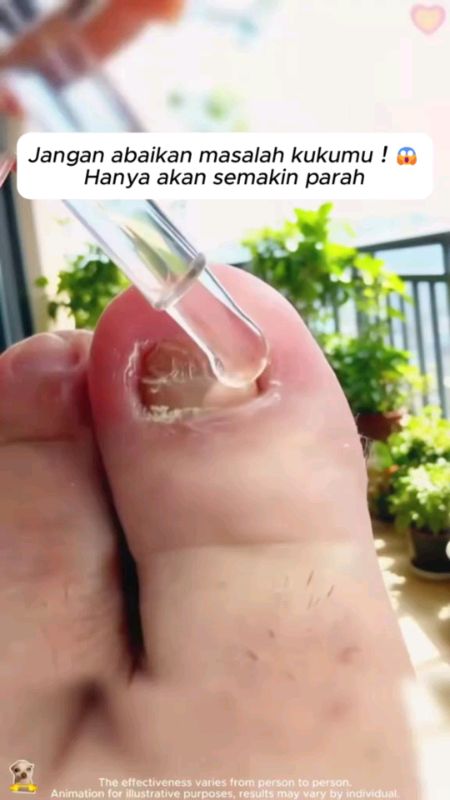 serum kuku#serumkuku #obatkukurusak #obatkukujamur #penghilangjamurkuku #serumkukujamuran #ViralDiShopeeVideo #RacunShopee #obatjamurkuku
